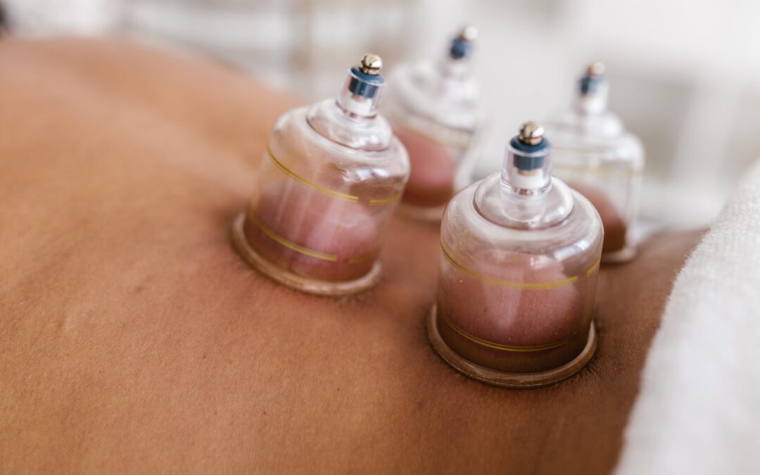 Myofascial Cupping